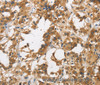 Immunohistochemistry of paraffin-embedded Human thyroid cancer tissue using DUSP23 Polyclonal Antibody at dilution 1:30