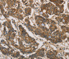 Immunohistochemistry of paraffin-embedded Human colon cancer tissue using UBE2S Polyclonal Antibody at dilution 1:40