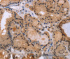 Immunohistochemistry of paraffin-embedded Human thyroid cancer tissue using KIF25 Polyclonal Antibody at dilution 1:40