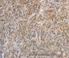 Immunohistochemistry of paraffin-embedded Human gastic cancer using ESRRG Polyclonal Antibody at dilution of 1:30