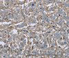 Immunohistochemistry of paraffin-embedded Human liver cancer using CD32 Polyclonal Antibody at dilution of 1:40