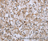Immunohistochemistry of paraffin-embedded Human prostate cancer using CD32 Polyclonal Antibody at dilution of 1:40