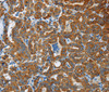 Immunohistochemistry of paraffin-embedded Human thyroid cancer tissue using FLCN Polyclonal Antibody at dilution 1:40