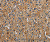 Immunohistochemistry of paraffin-embedded Human liver cancer tissue using FLCN Polyclonal Antibody at dilution 1:40