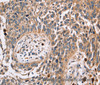 Immunohistochemistry of paraffin-embedded Human lung cancer using FUCA1 Polyclonal Antibody at dilution of 1:30