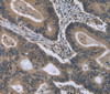 Immunohistochemistry of paraffin-embedded Human colon cancer using MCM3AP Polyclonal Antibody at dilution of 1:30