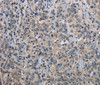 Immunohistochemistry of paraffin-embedded Human liver cancer using MCM3AP Polyclonal Antibody at dilution of 1:30