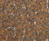 Immunohistochemistry of paraffin-embedded Human liver cancer tissue using ID2 Polyclonal Antibody at dilution 1:30