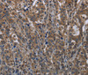 Immunohistochemistry of paraffin-embedded Human liver cancer tissue using TSC22D3 Polyclonal Antibody at dilution 1:40