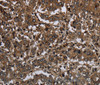 Immunohistochemistry of paraffin-embedded Human liver cancer tissue using GLIPR1 Polyclonal Antibody at dilution 1:50