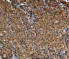 Immunohistochemistry of paraffin-embedded Human thyroid cancer using GLO1 Polyclonal Antibody at dilution of 1:50