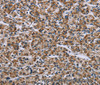Immunohistochemistry of paraffin-embedded Human prostate cancer tissue using GTPBP10 Polyclonal Antibody at dilution 1:60