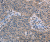 Immunohistochemistry of paraffin-embedded Human lung cancer using p53RFP Polyclonal Antibody at dilution of 1:50