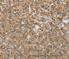 Immunohistochemistry of paraffin-embedded Human prostate cancer using TXLNA Polyclonal Antibody at dilution of 1:30