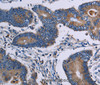 Immunohistochemistry of paraffin-embedded Human colon cancer tissue using ITK Polyclonal Antibody at dilution 1:50