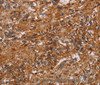 Immunohistochemistry of paraffin-embedded Human ovarian cancer tissue using JAKMIP2 Polyclonal Antibody at dilution 1:40