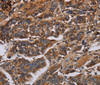 Immunohistochemistry of paraffin-embedded Human breast cancer using KCNQ1 Polyclonal Antibody at dilution of 1:50