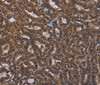 Immunohistochemistry of paraffin-embedded Human thyroid cancer tissue using KLK8 Polyclonal Antibody at dilution 1:50