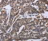Immunohistochemistry of paraffin-embedded Human breast cancer tissue using DDX11 Polyclonal Antibody at dilution 1:30