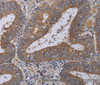 Immunohistochemistry of paraffin-embedded Human colon cancer using ZC3H12A Polyclonal Antibody at dilution of 1:40