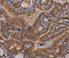 Immunohistochemistry of paraffin-embedded Human thyroid cancer using MCTS1 Polyclonal Antibody at dilution of 1:60
