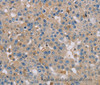 Immunohistochemistry of paraffin-embedded Human breast cancer using CLIC1 Polyclonal Antibody at dilution of 1:30