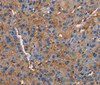 Immunohistochemistry of paraffin-embedded Human liver cancer tissue using NLGN1 Polyclonal Antibody at dilution 1:50