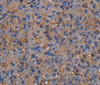 Immunohistochemistry of paraffin-embedded Human liver cancer tissue using NRIP3 Polyclonal Antibody at dilution 1:60