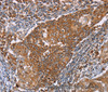 Immunohistochemistry of paraffin-embedded Human cervical cancer tissue using PMPCB Polyclonal Antibody at dilution 1:50