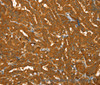 Immunohistochemistry of paraffin-embedded Human thyroid cancer using PYGM Polyclonal Antibody at dilution of 1:30