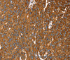 Immunohistochemistry of paraffin-embedded Human breast cancer tissue using RASSF3 Polyclonal Antibody at dilution 1:35