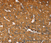 Immunohistochemistry of paraffin-embedded Human liver cancer tissue using RASSF3 Polyclonal Antibody at dilution 1:35