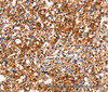 Immunohistochemistry of paraffin-embedded Human prostate cancer tissue using TRIM69 Polyclonal Antibody at dilution 1:40
