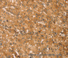 Immunohistochemistry of paraffin-embedded Human liver cancer tissue using SNAP29 Polyclonal Antibody at dilution 1:45