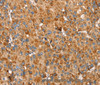 Immunohistochemistry of paraffin-embedded Human liver cancer using SSBP1 Polyclonal Antibody at dilution of 1:30