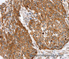 Immunohistochemistry of paraffin-embedded Human lung cancer using SSBP1 Polyclonal Antibody at dilution of 1:30