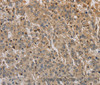 Immunohistochemistry of paraffin-embedded Human liver cancer using ADO Polyclonal Antibody at dilution of 1:30