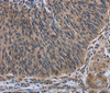 Immunohistochemistry of paraffin-embedded Human lung cancer using AVEN Polyclonal Antibody at dilution of 1:30
