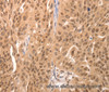 Immunohistochemistry of paraffin-embedded Human breast cancer tissue using JUND Polyclonal Antibody at dilution 1:60