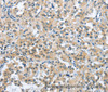 Immunohistochemistry of paraffin-embedded Human thyroid cancer tissue using TRDMT1 Polyclonal Antibody at dilution 1:40