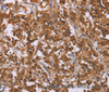 Immunohistochemistry of paraffin-embedded Human thyroid cancer using CMTM6 Polyclonal Antibody at dilution of 1:30