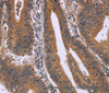 Immunohistochemistry of paraffin-embedded Human colon cancer using CMTM6 Polyclonal Antibody at dilution of 1:30
