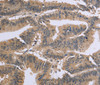 Immunohistochemistry of paraffin-embedded Human colon cancer tissue using GSN Polyclonal Antibody at dilution 1:40