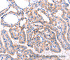 Immunohistochemistry of paraffin-embedded Human thyroid cancer tissue using GRK2 Polyclonal Antibody at dilution 1:87