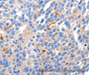 Immunohistochemistry of paraffin-embedded Human liver cancer tissue using KCNH8 Polyclonal Antibody at dilution 1:50