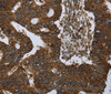 Immunohistochemistry of paraffin-embedded Human colon cancer using PPP1R13L Polyclonal Antibody at dilution of 1:30