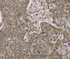 Immunohistochemistry of paraffin-embedded Human liver cancer tissue using IL15RA Polyclonal Antibody at dilution 1:45