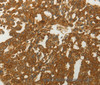 Immunohistochemistry of paraffin-embedded Human lung cancer tissue using MC4R Polyclonal Antibody at dilution 1:50