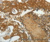 Immunohistochemistry of paraffin-embedded Human breast cancer using MCM4 Polyclonal Antibody at dilution of 1:40