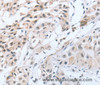 Immunohistochemistry of paraffin-embedded Human lung cancer tissue using CHRNA10 Polyclonal Antibody at dilution 1:50